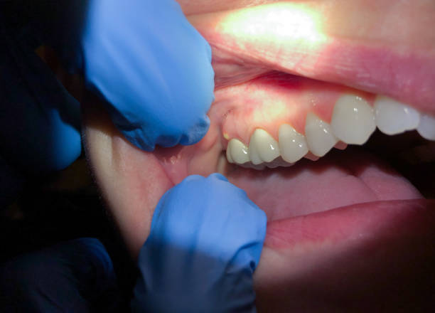 Best Emergency Denture Repair in Harper, KS